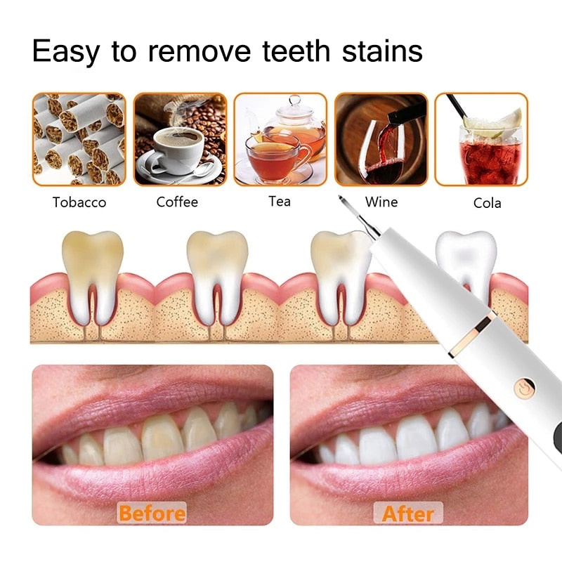 Electric Sonic Dental Calculus Scaler with ergonomic design and LED light for effective teeth cleaning.