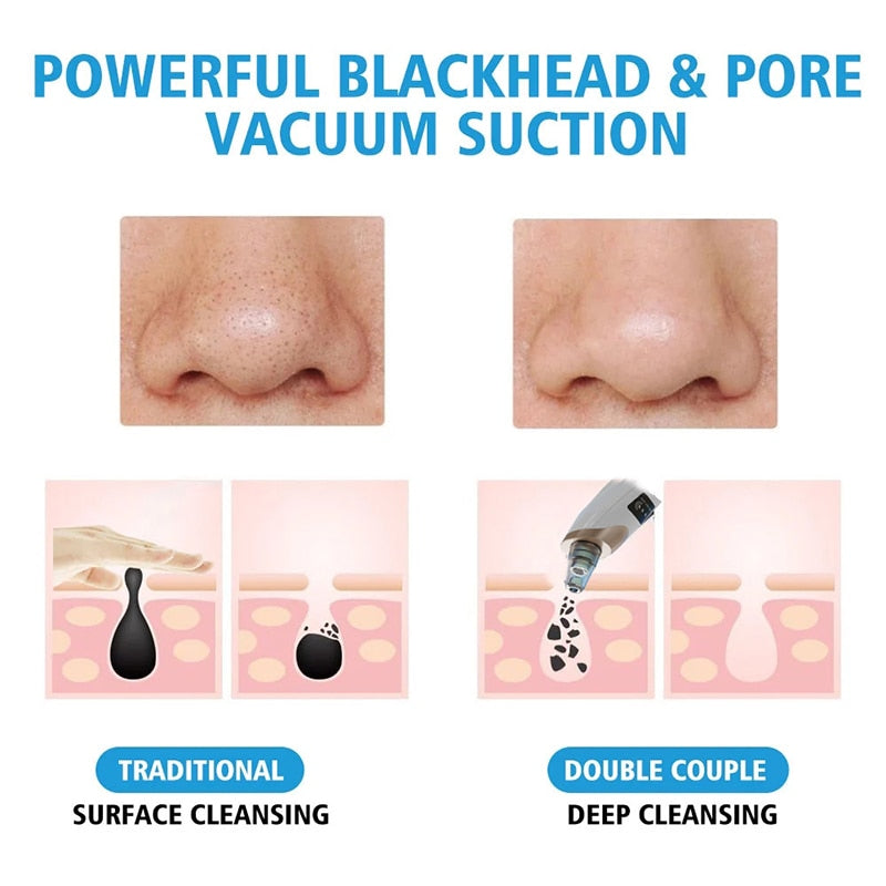 Electric Facial Blackhead Remover Vacuum with multiple replacement heads and USB charging cable, designed for effective acne and blackhead removal.