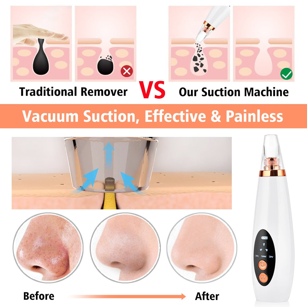 Facial Pore Cleaner Blackhead Remover Vacuum Suction Cleaner with multiple suction heads and USB charging cable, designed for effective skincare.