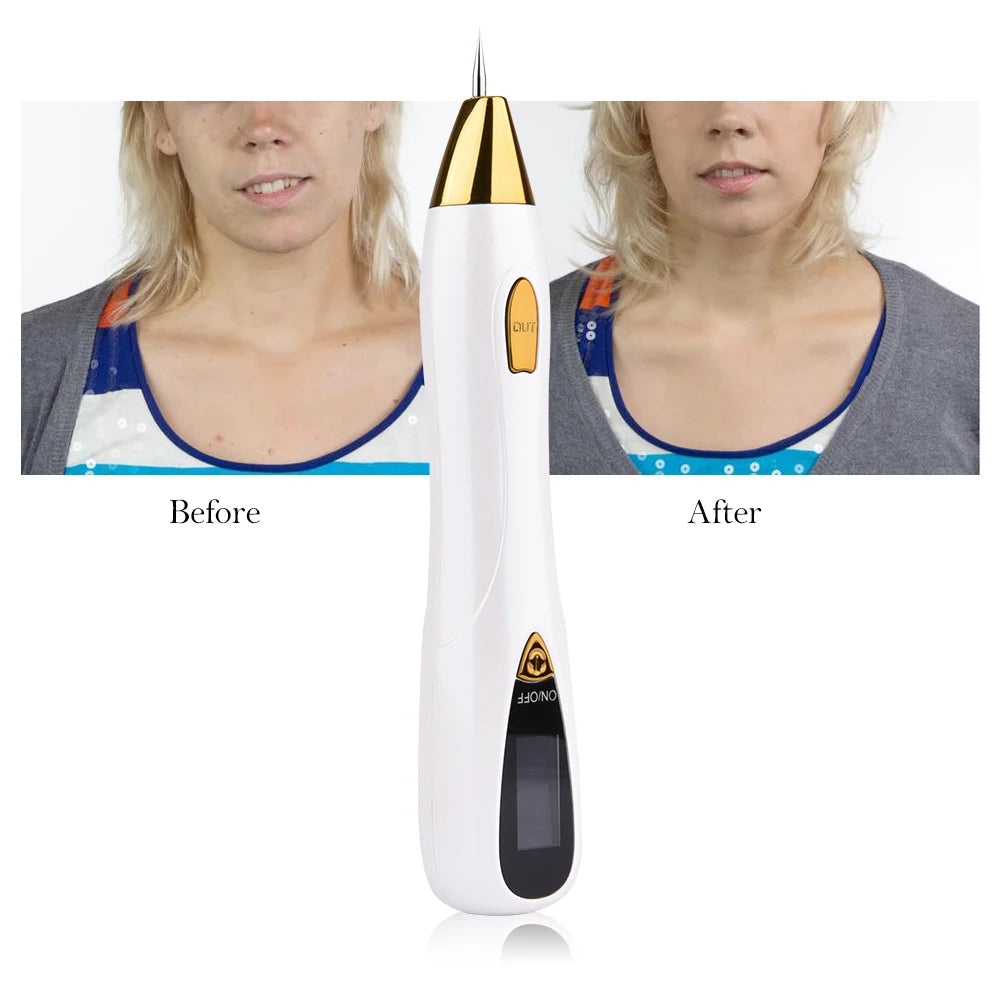 Mole Removal Pen with LCD display and various needle attachments for professional skin treatment.