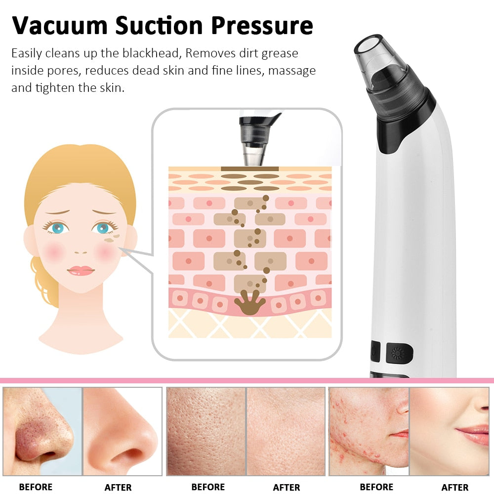 Nose Cleaner T Zone Pore Acne Pimple Removal device with adjustable suction levels and interchangeable heads, designed for effective blackhead removal.