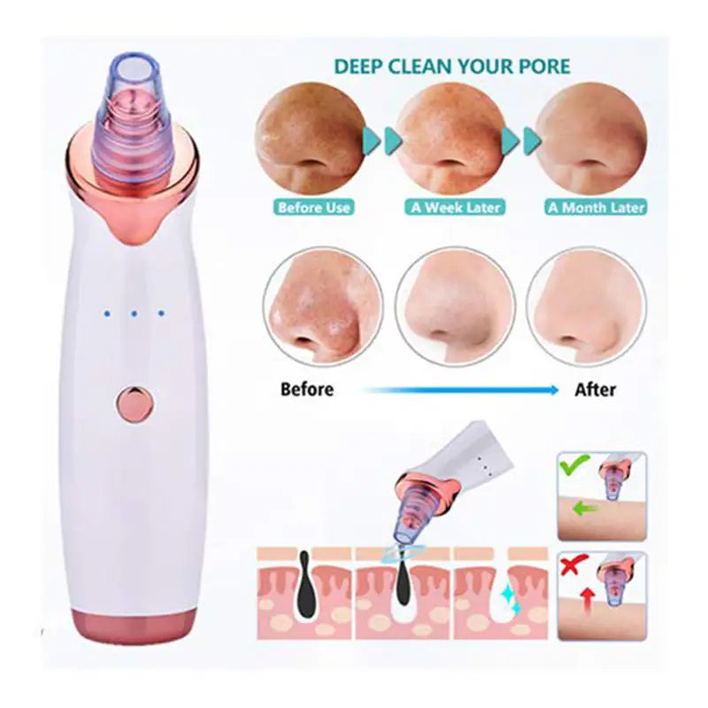 Blackhead Remover Vacuum device with ergonomic design and USB charging port, ideal for effective pore cleansing.